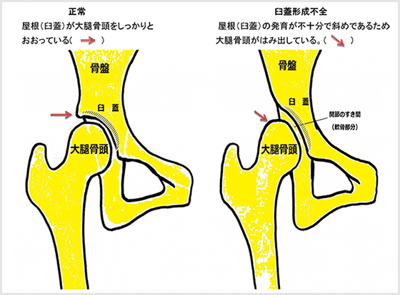 臼蓋形成不全とは